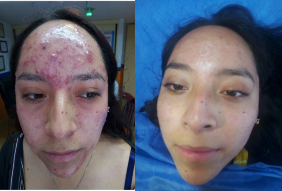 dermatologos para el acne