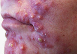 acné, tratamiento del acné, dermatólogos en toluca