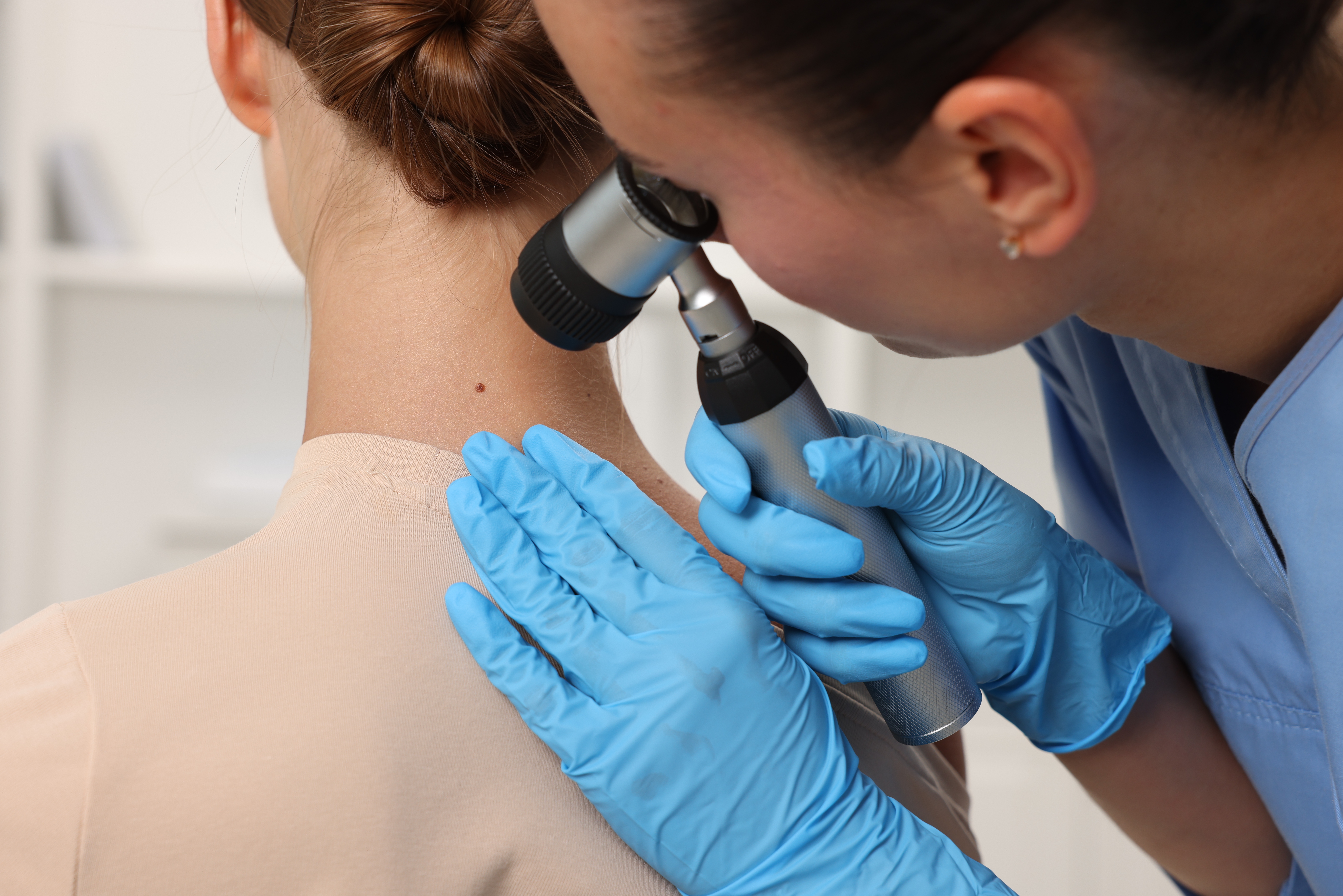 Doctor examining young woman's mole with dermatoscope in hospital, closeup